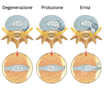 protrusione-ernia-differenza